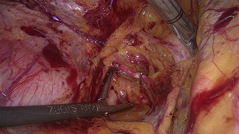 Laparoscopic Hysterectomy Masterclass: Hands-On